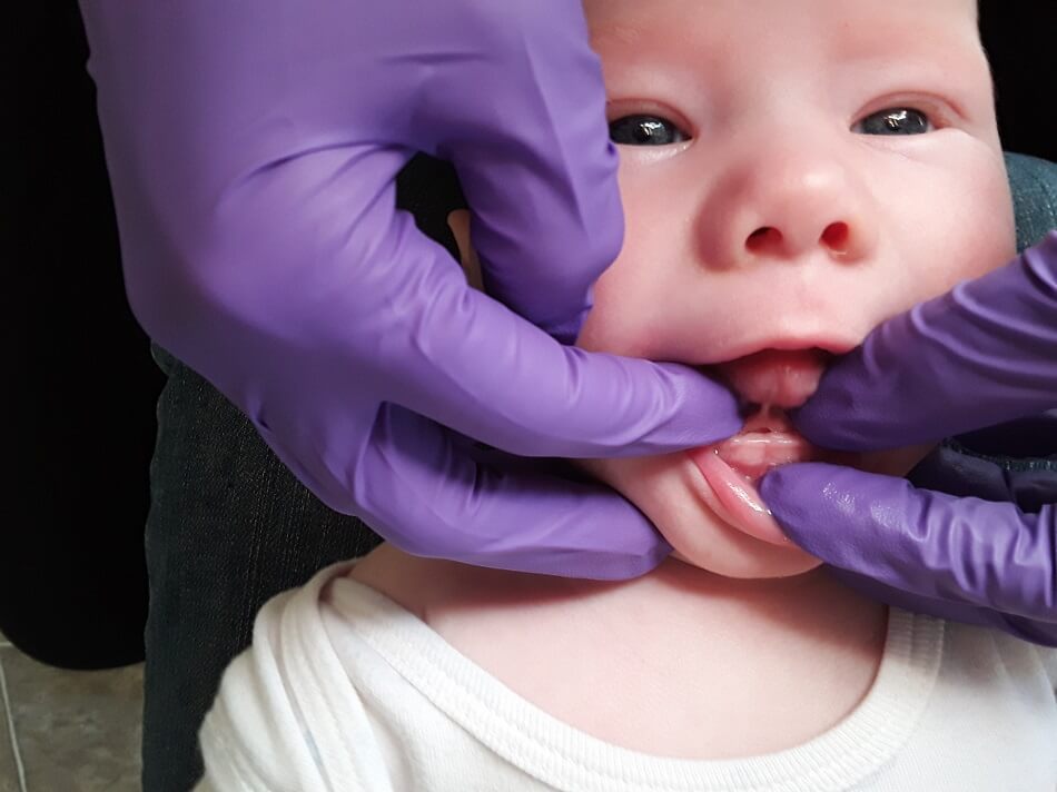 Tongue tie in baby Tongue tie in baby